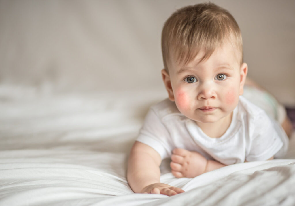 Kinderleiden Atopische Dermatitis