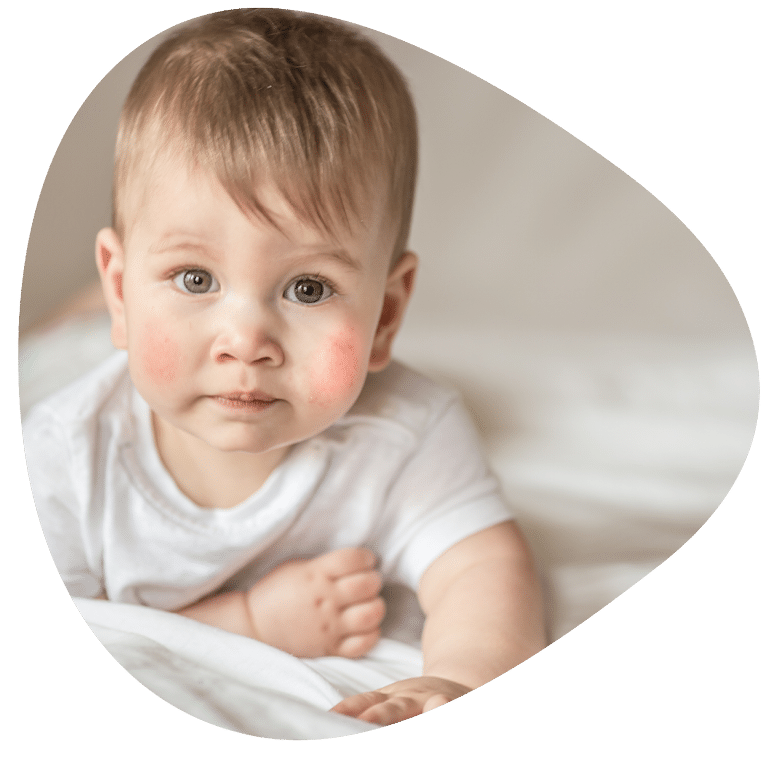 Kinderleiden Atopische Dermatitis
