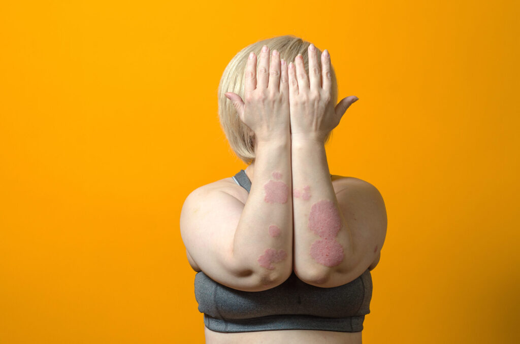 Psoriasis und Co: Gut geschützt durch den Sommer mit Hauterkrankungen